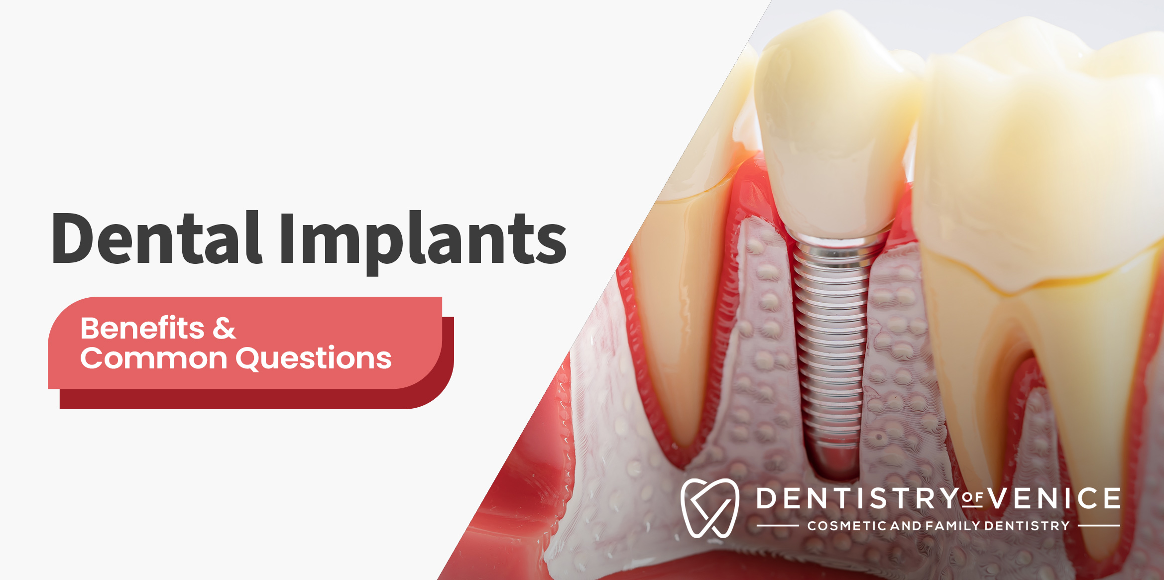 Dental Implants Benefits