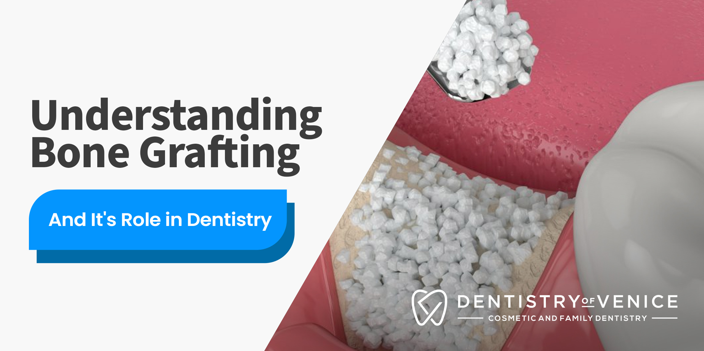 Bone Grafting