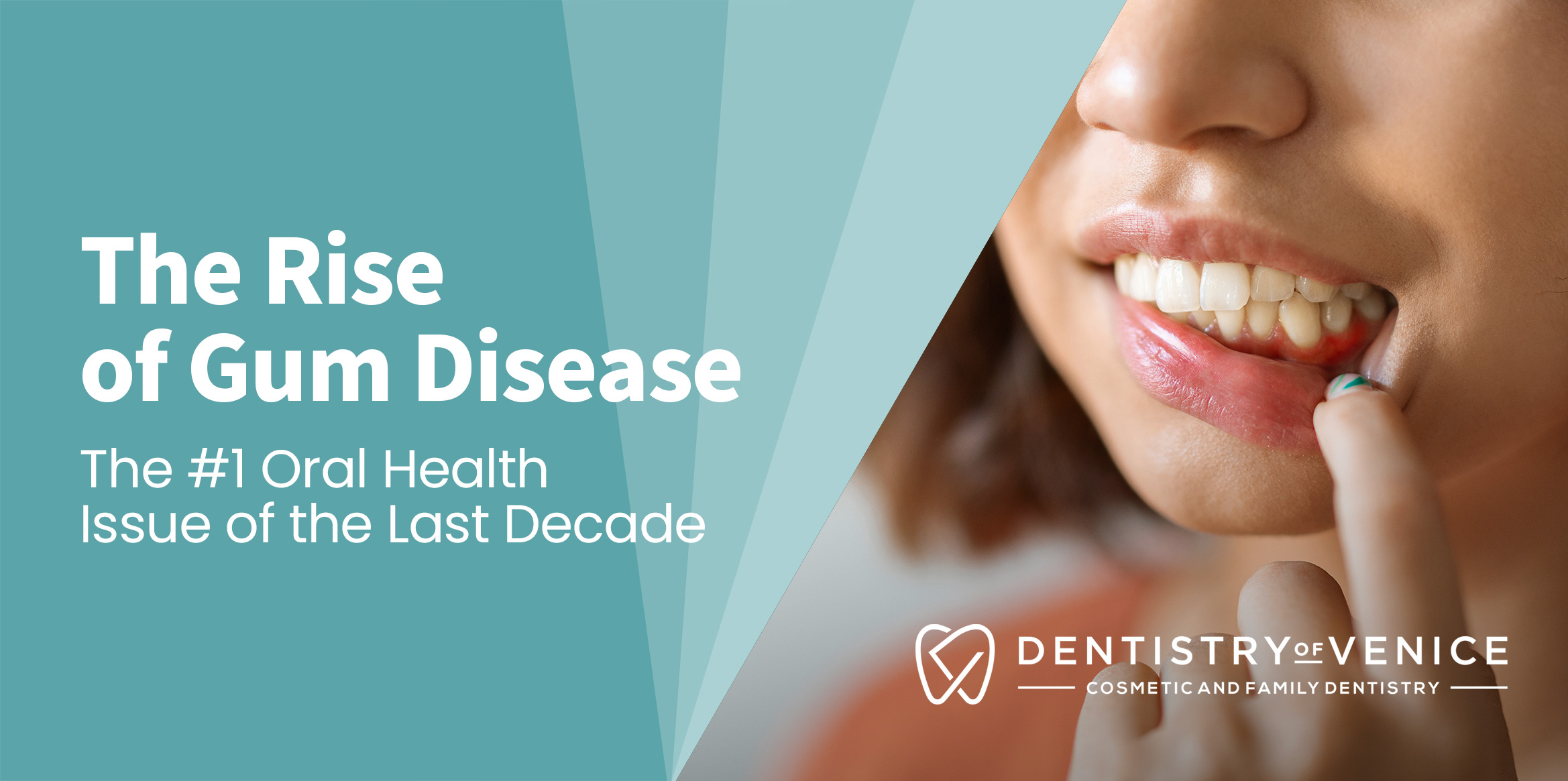 The Rise of Gum Disease